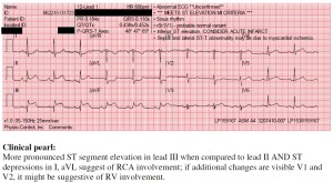 STEMI Stafford to HH 2