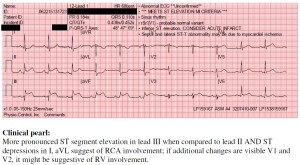 STEMI Stafford to HH 2