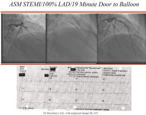 STEMI UConn